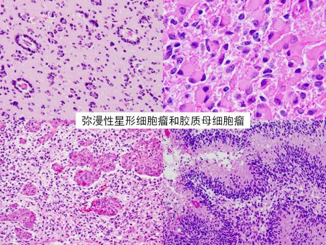 [病理诊断]广东省人民医院李智:胶质瘤的病理诊断 从组织学表型到分子