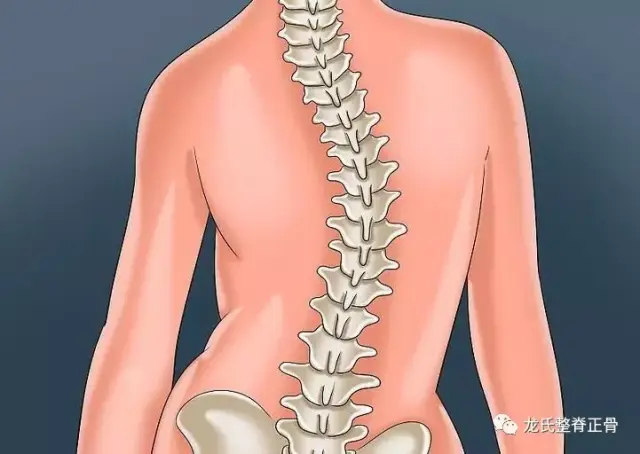 脊柱侧弯的治疗手法及操作要领