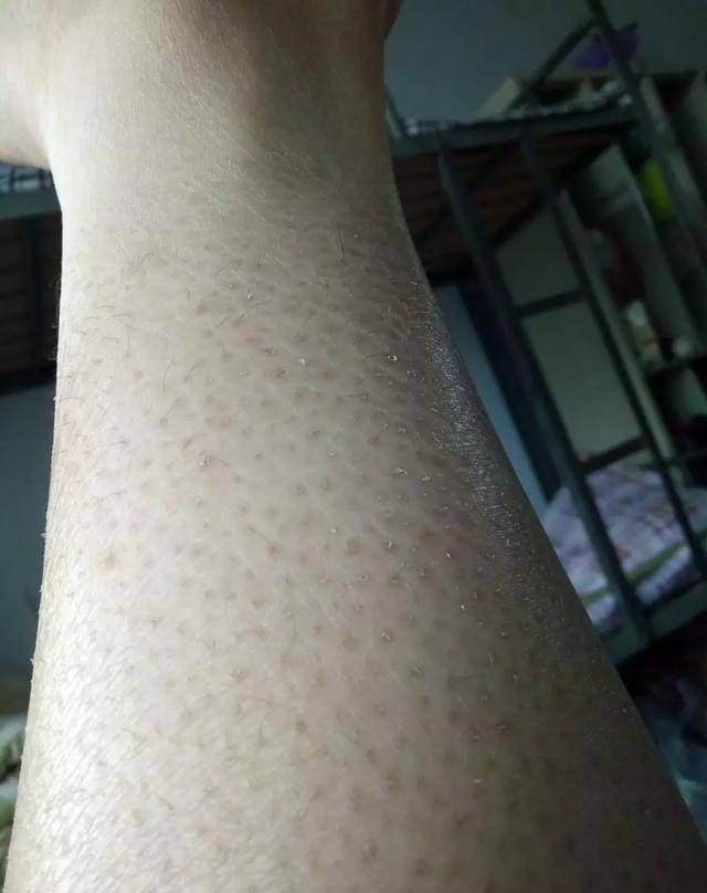 鸡皮肤图片?鸡皮肤什么样?