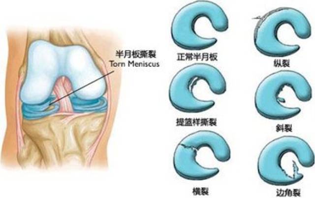 膝盖疼痛,打软?骨科医生车向东:做好这五点有效预防半月板受伤