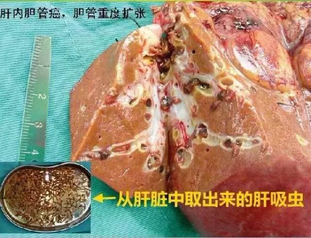 注意了,五华一男子胆管全是虫子,竟是因为吃了.
