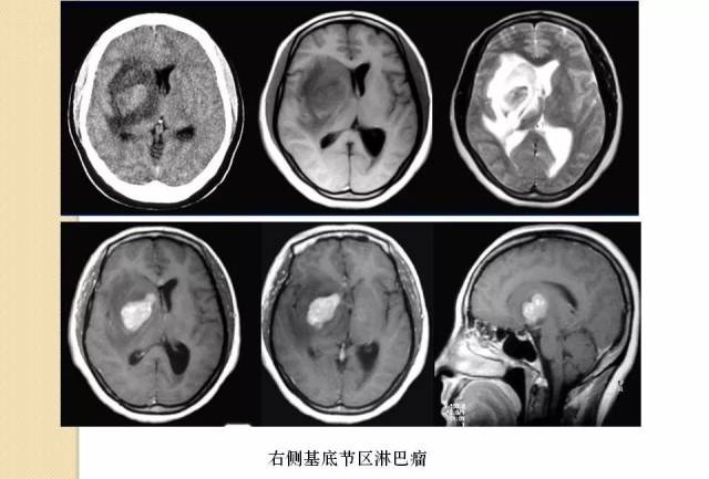 [演讲]天坛医院孙胜军:原发性中枢神经系统淋巴瘤影像