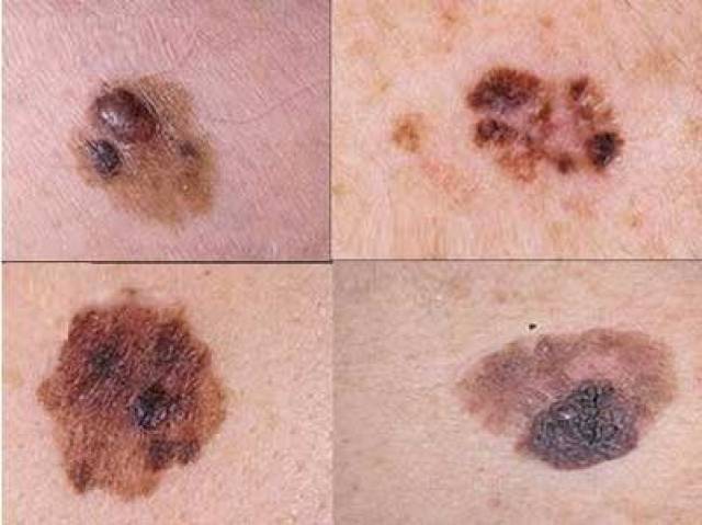 如何检查自己有没有得皮肤癌皮肤癌的早期特征和自检方法