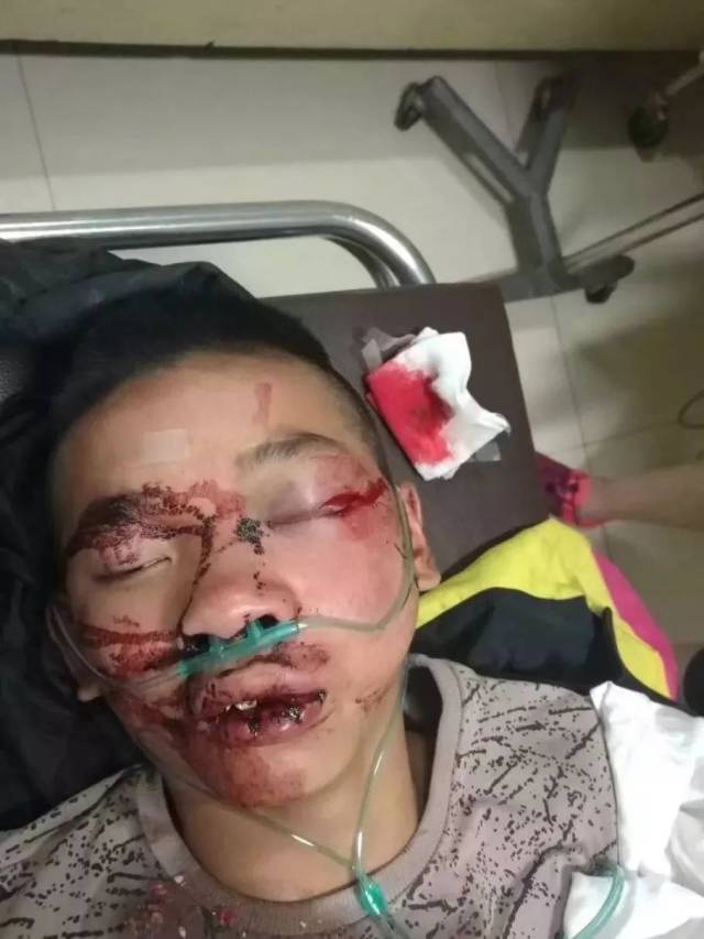 两个14岁小男孩在玉龙县发生车祸!