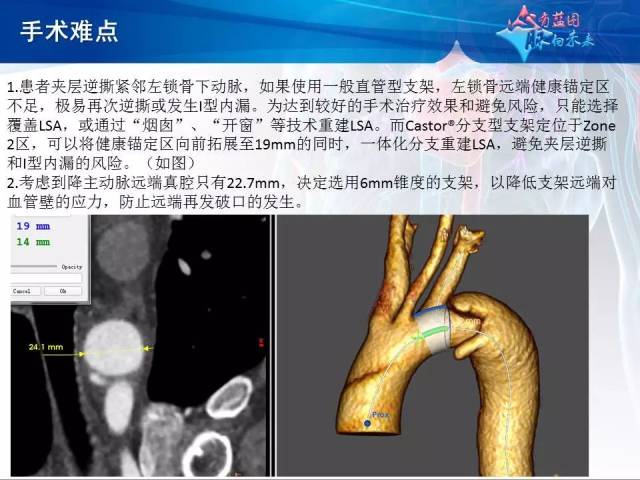 【病例分享】运用castor分支型主动脉覆膜支架系统治疗胸主动脉逆撕型