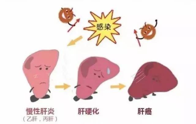 [疾病科普]世界肝炎日:带你认识五种病毒性肝炎