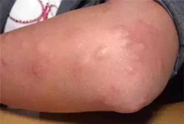 被蠓虫叮咬后的症状 被蠓虫叮咬时基本无感觉,但叮咬后的后果是比较