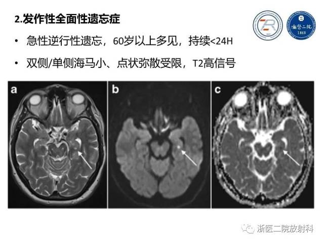 海马正常解剖及病变介绍