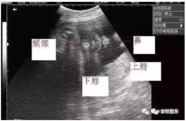 图文详解:胎儿超声标准切面怎么看?产科医生必读!