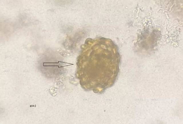 图1 虫卵名称:未受精蛔虫卵 虫卵的特征: 大小:8894umx3944um 形状