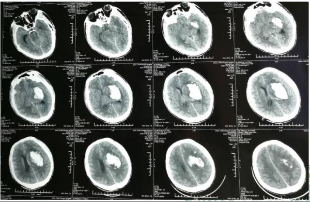 2018-2-16头颅cta(发病日): 左侧大脑中动脉m2-m5段受压显影欠佳,部分