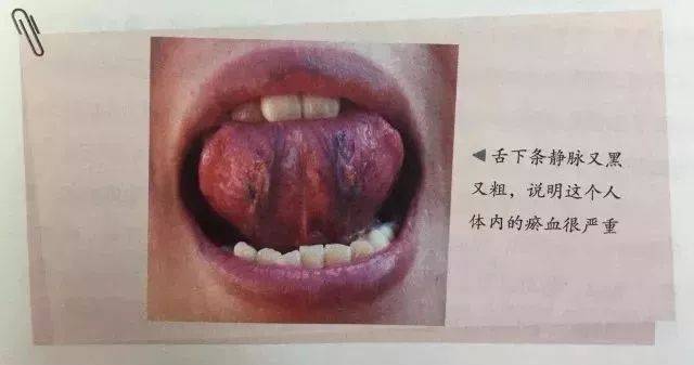 舌头下有两条静脉,正常应该是淡青色,直径不超过2毫米.
