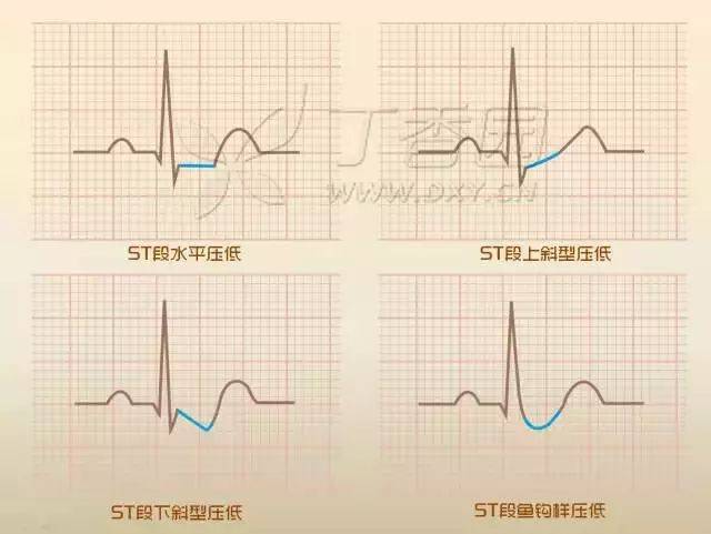 你对 st 段的理解可能错了