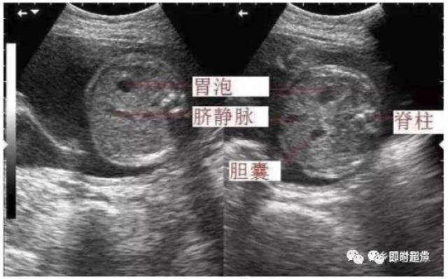 测量胎儿腹围的标准切面是 胃泡及静脉导管的横切面.