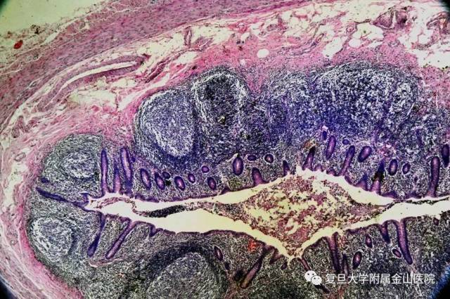 显微镜下的阑尾炎切片