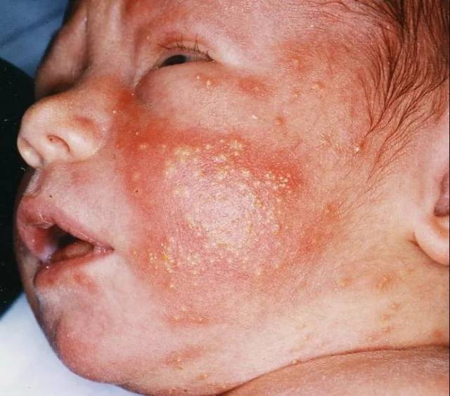 婴儿湿疹 or 痤疮?鉴别要点一文掌握