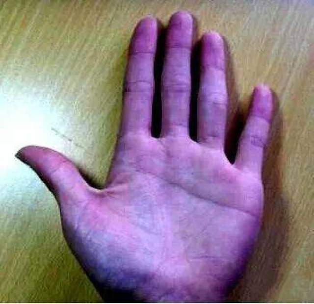 2,手掌看上去发紫.