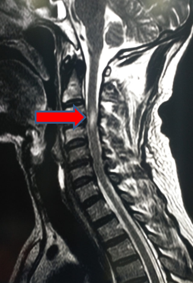 磁共振提示颈3-4水平脊髓损伤,颈椎管狭窄