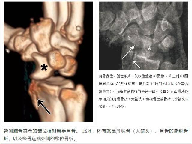 腕关节大全--解剖,骨折,脱位,值得收藏!