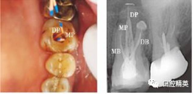 上颌第一磨牙腭侧双根管1例