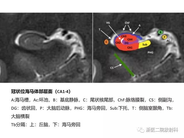 精彩幻灯:海马正常解剖及病变介绍