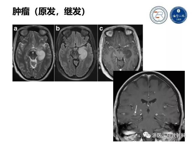 精彩幻灯:海马正常解剖及病变介绍