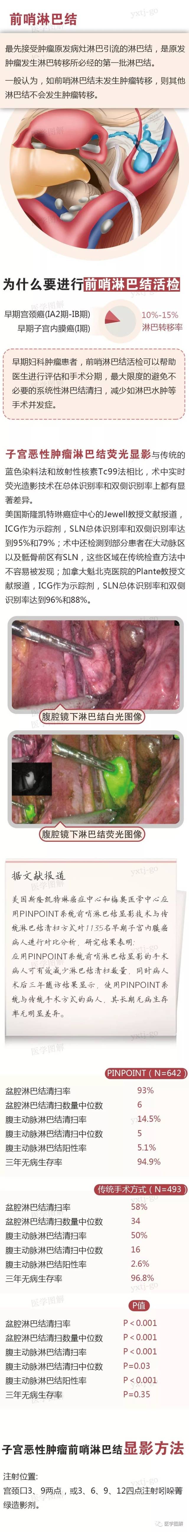 精准妇科之精准定位前哨淋巴结