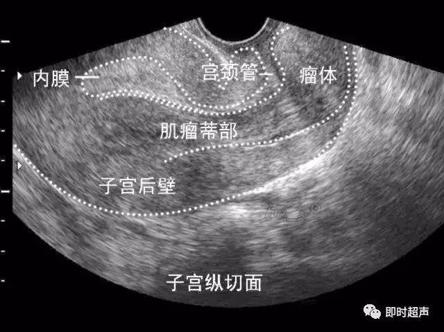 子宫肌瘤超声分类诊断