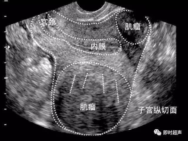 图8-3-8 多发性浆膜下子宫肌瘤声像(经阴道扫查)