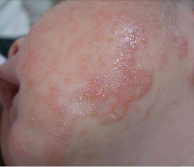 宝宝湿疹痛痒不止,按摩这几个穴位,就能轻松搞定湿疹