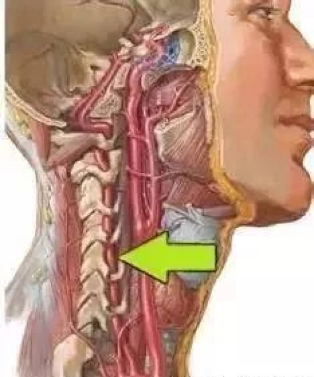 颈交感神经受刺激是椎动脉型颈椎病的发病原因之一