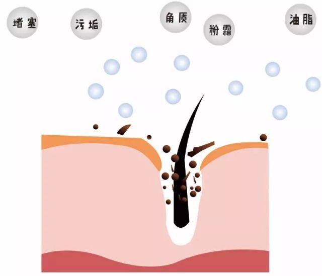 ②清洁不当,以及角质,粉霜残留堵塞在毛孔中.