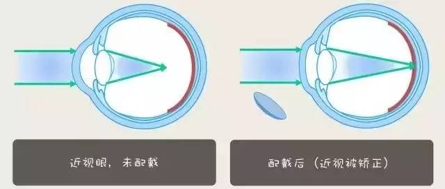 配戴角膜塑形镜,会影响将来近视激光手术吗?