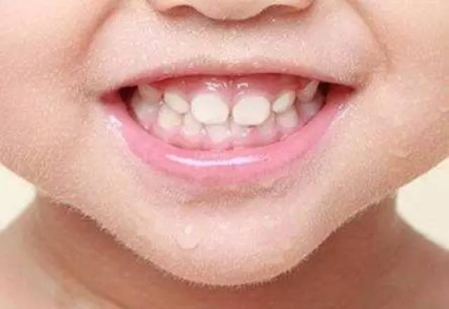 影响口腔及面部发育.如我们常说的"龅牙","地包天". 4.