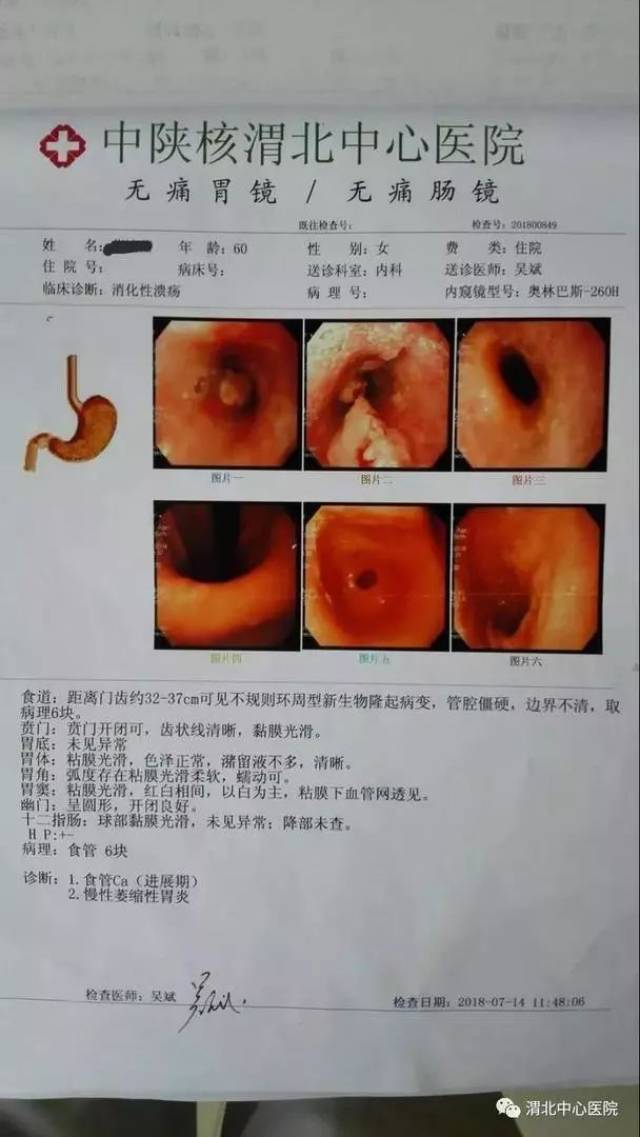 渭北中心医院成功实施一例高难度食管癌手术