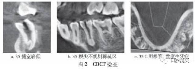 下颌第二前磨牙牛牙症伴畸形中央尖及c型根管1例