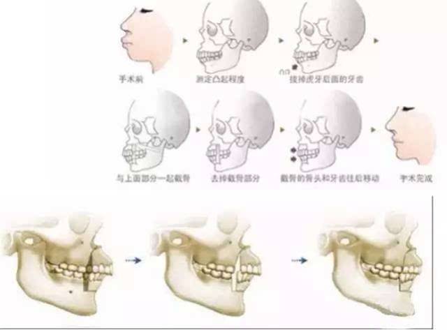 箍牙可以解决上下牙槽骨前突的问题吗