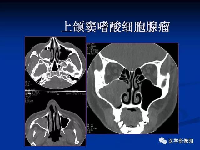 鼻腔,鼻窦良,恶性肿瘤的ctmr诊断(一) | 影像天地