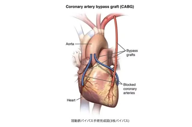 冠状动脉搭桥手术完成图