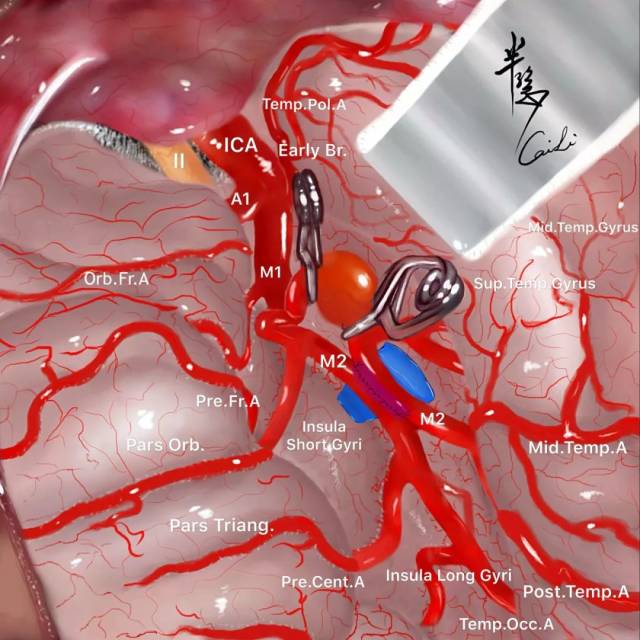 半隐画画:脑血管搭桥手术