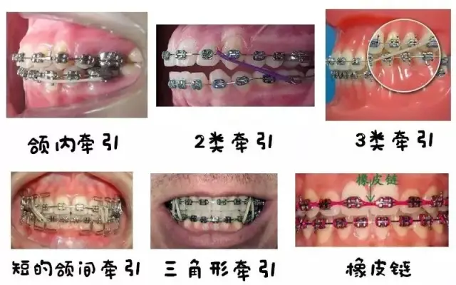 不管是隐形矫正还是固定矫正,医生都可能会需要你自行配戴橡皮筋,挂在