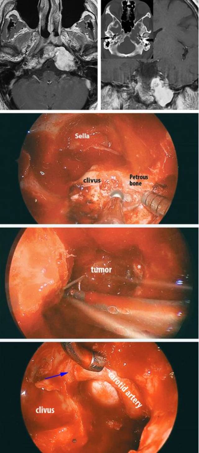 脊索瘤和软骨肉瘤手术策略与技巧 | the neurosurgical atlas全文翻译