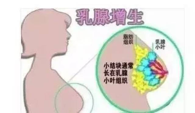 【女性健康】什么是乳腺增生?乳腺增生你了解多少?