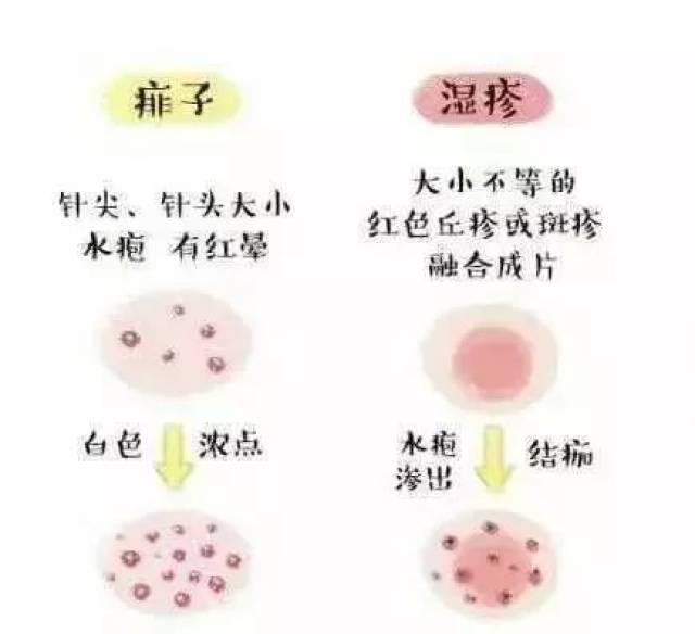 湿疹和痱子的主要区别 1  爆发季节不同 湿疹是一年四季都容易长,而