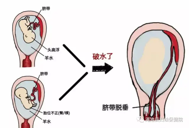 【母婴健康】破水到底啥感觉