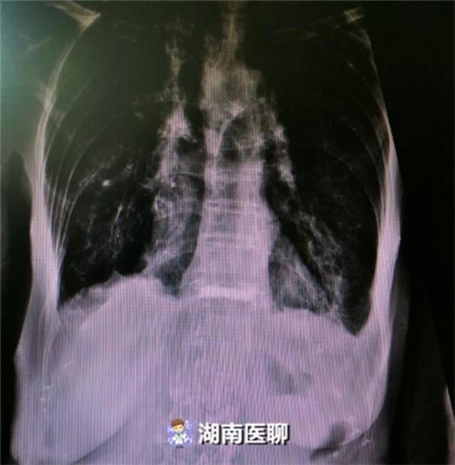 九旬老太日夜煎熬胸背疼痛似刀割,骨头变"脆"变"空"致