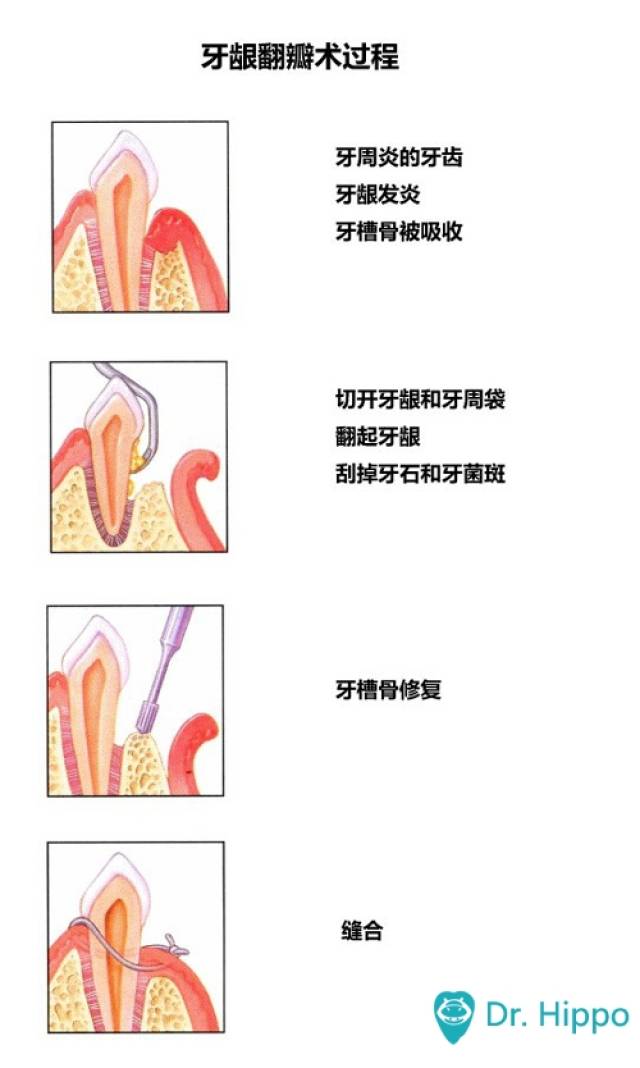 这样可以达到使牙周袋变浅,促进骨修复的目的.