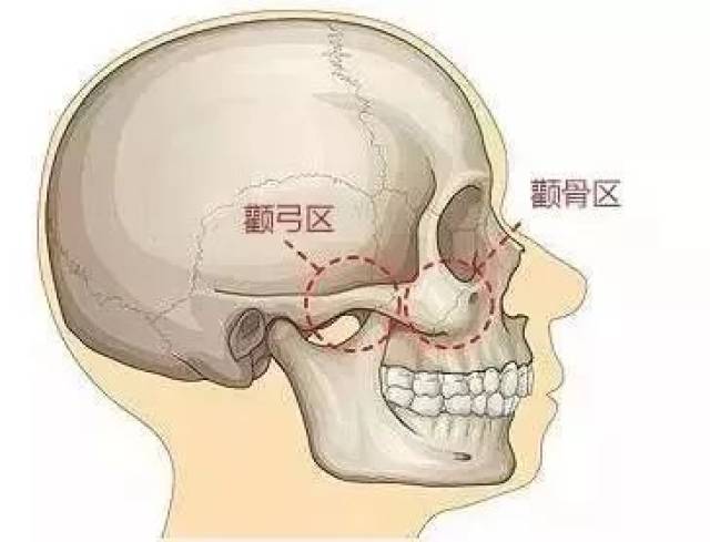 颧弓位于面中部的外侧,形成面颊部的骨性凸起呈向外的弓形,它是颧骨向