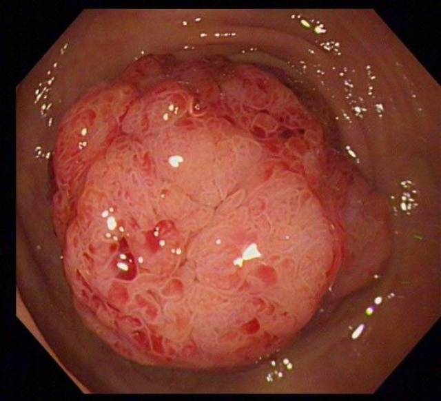 冠县中心医院消化内科成功对"巨大结肠腺瘤并高级别瘤变 患者行结肠