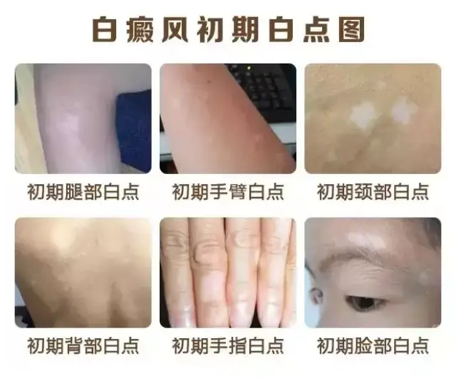 那么是很难发现的,很容易被忽视,白斑处的肌肤与正常肌肤相同,没有